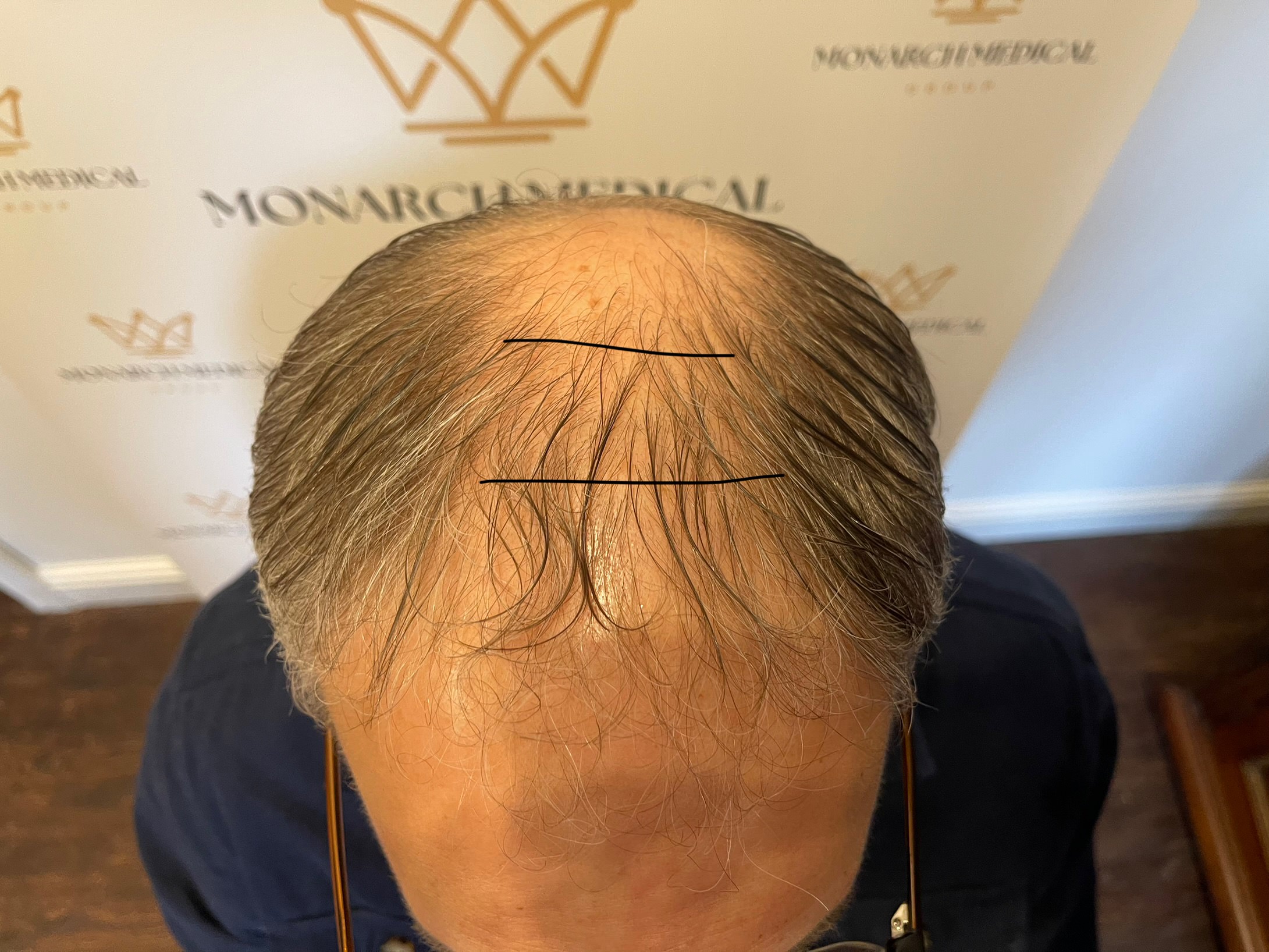 Norwood 7 hair transplant — Colin result photo 2